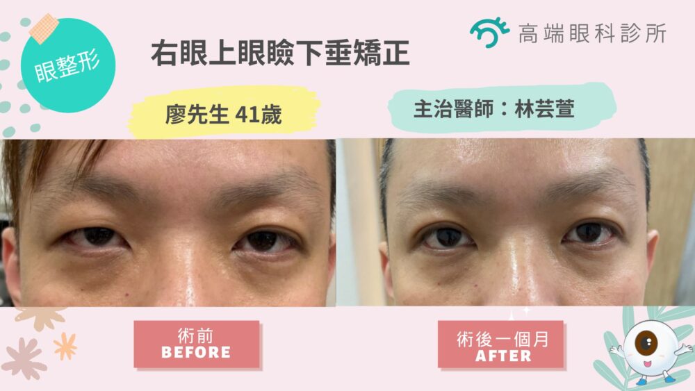 眼整形案例分享－右眼上眼瞼下垂矯正 - ｜白內障治療｜近視控制方法