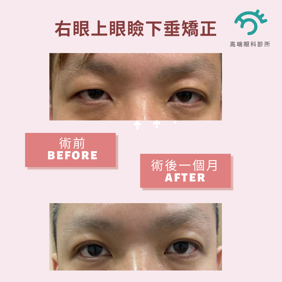 眼整形案例分享－右眼上眼瞼下垂矯正 - ｜白內障治療｜近視控制方法