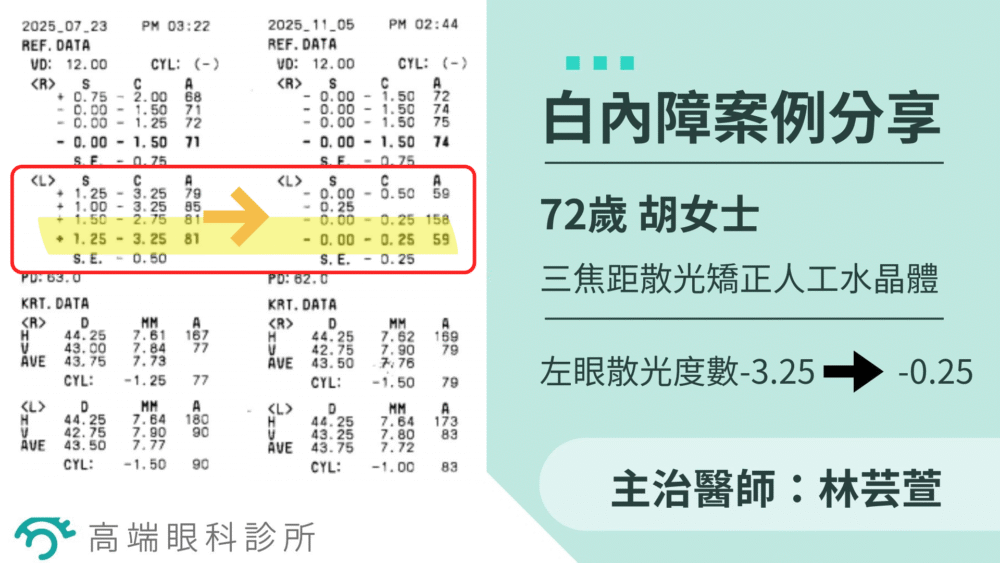 白內障案例